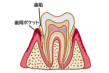 1. 歯周ポケットの「奥」まで届く