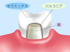 ジルコニア