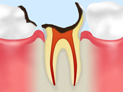 C3【神経まで達した虫歯】