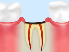 C4【歯根まで達した虫歯】