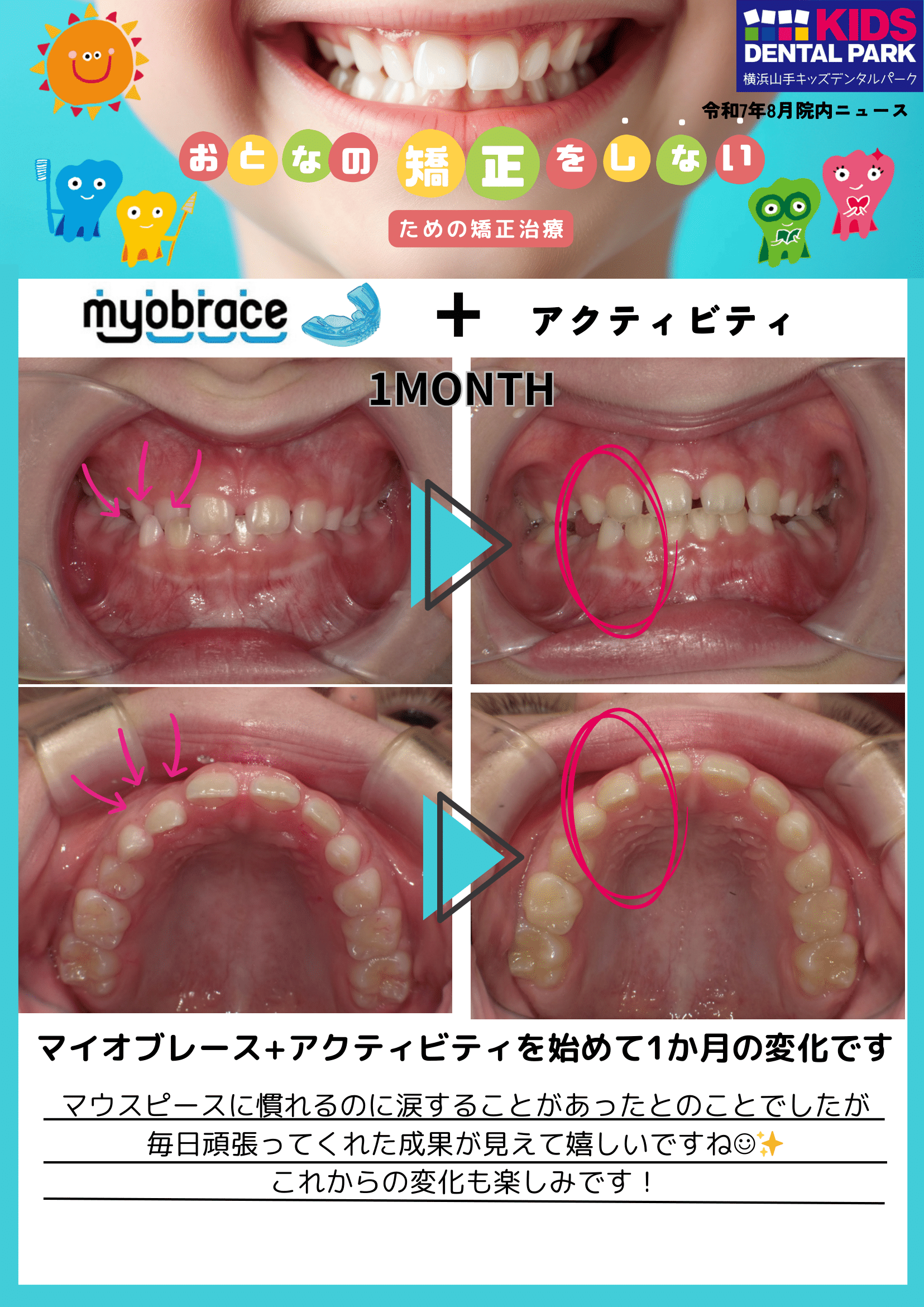 マイオブレース矯正とアクティビティを初めて1ヶ月の変化 - お知らせ 